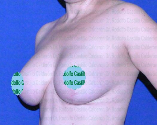 Breast Lift Implant change + Capsulectomy + Breast lift - After