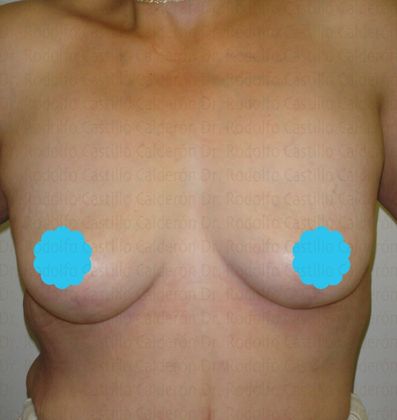 Breast Lift: Extended Breast Lift in after masssive weight loss patient - After