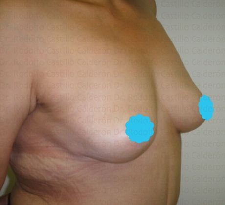 Breast Lift: Extended Breast Lift in after masssive weight loss patient - After