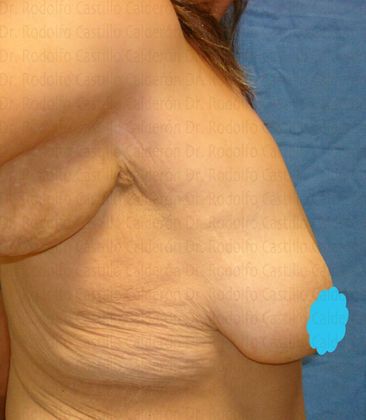 Breast Lift: Extended Breast Lift in after masssive weight loss patient - Before