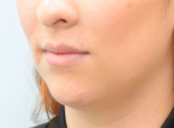 Chin augmentation: -Mentoplastía - Before