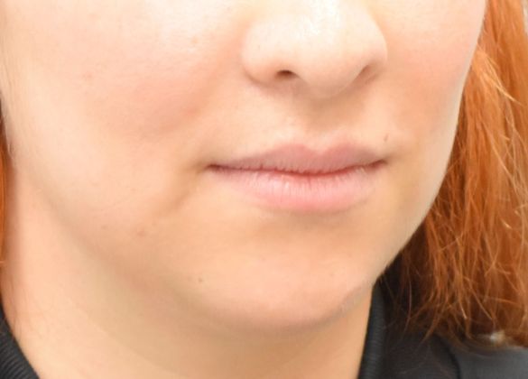 Chin augmentation: -Mentoplastía - Before