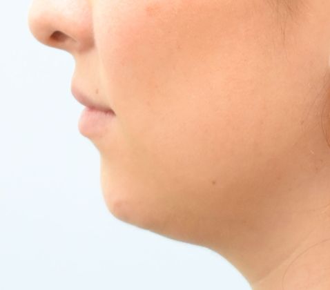 Chin augmentation: -Mentoplastía - Before