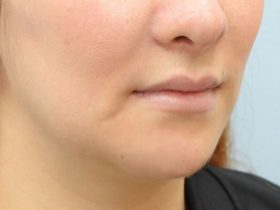 Chin augmentation: -Mentoplastía - After