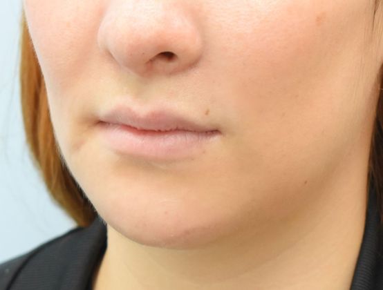 Chin augmentation: -Mentoplastía - After