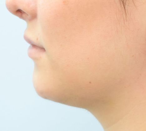 Chin augmentation: -Mentoplastía - After
