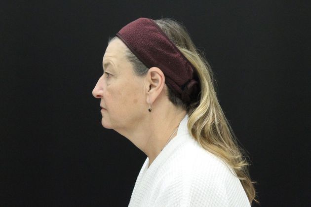 Face & Neck Lifts: Case 8 - Before