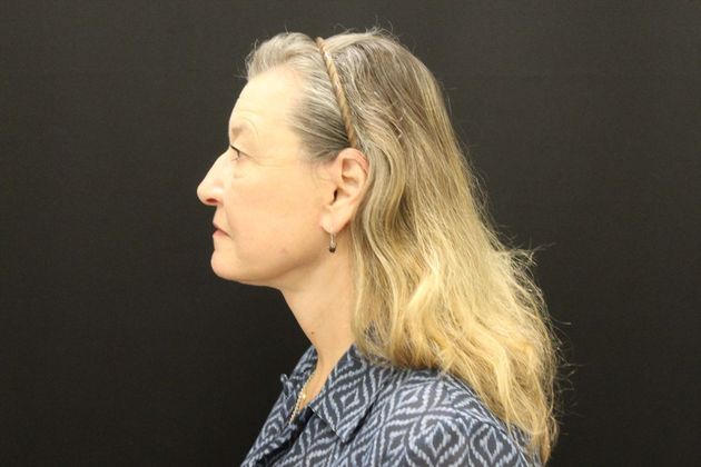 Face & Neck Lifts: Case 8 - After