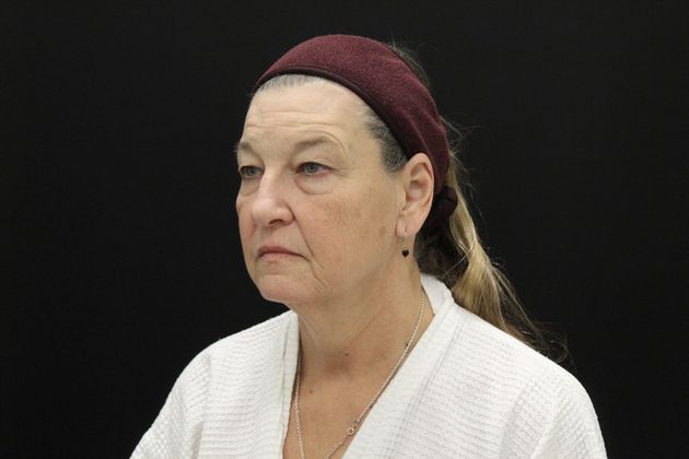 Face & Neck Lifts Case 8 - Before