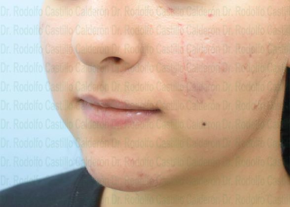 Chin augmentation: Rhinoplasty + Chin Implant + Bichatectomy Images - Before