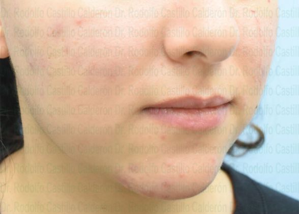 Chin augmentation Rhinoplasty + Chin Implant + Bichatectomy Images - Before
