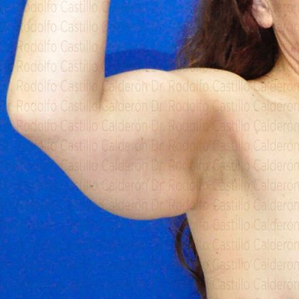 Arm Lift: Arm Lift - Before