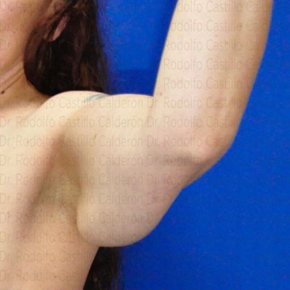 Arm Lift: Arm Lift - Before