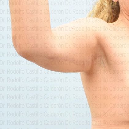 Arm Lift: Arm Lift - After