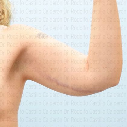 Arm Lift: Arm Lift - After