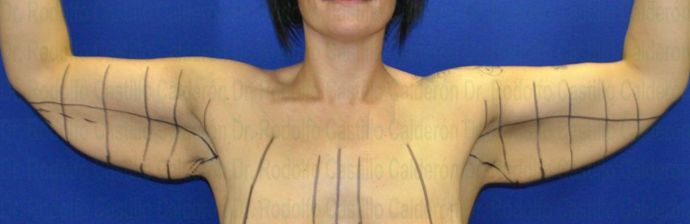 Arm Lift: Arm Lift + Breast Lift - Before