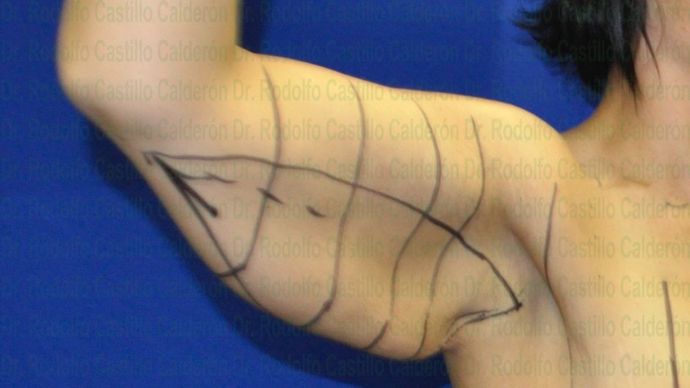 Arm Lift: Arm Lift + Breast Lift - Before