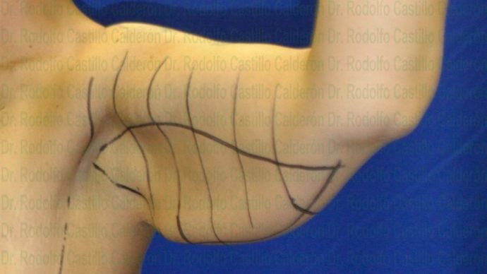 Arm Lift: Arm Lift + Breast Lift - Before