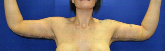 Arm Lift: Arm Lift + Breast Lift - After five days