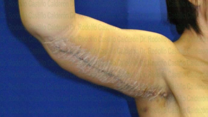 Arm Lift: Arm Lift + Breast Lift - After five days