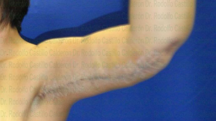 Arm Lift: Arm Lift + Breast Lift - After five days