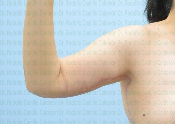 Arm Lift: Extended Arm Lift + Posterior Upper Body Lift - After