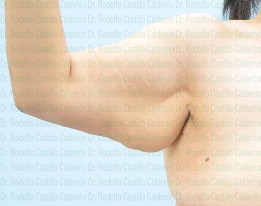 Arm Lift: Extended Arm Lift + Posterior Upper Body Lift - Before