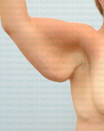 Arm Lift: -Extended Arm Lift + Posterior Upper Body Lift - Before