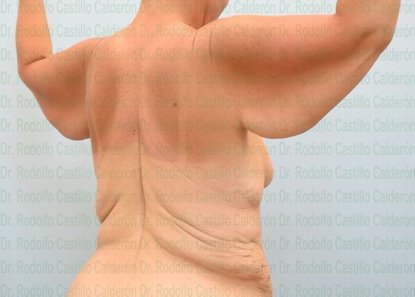 Arm Lift: -Extended Arm Lift + Posterior Upper Body Lift - Before