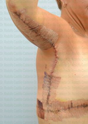 Arm Lift: -Extended Arm Lift + Posterior Upper Body Lift - After five days