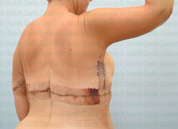 Arm Lift: -Extended Arm Lift + Posterior Upper Body Lift - After five days