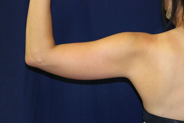 Arm Lift*/Arm Sculpting: Case 13 - Before