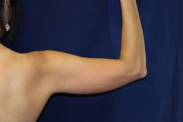 Arm Lift*/Arm Sculpting: Case 13 - Before