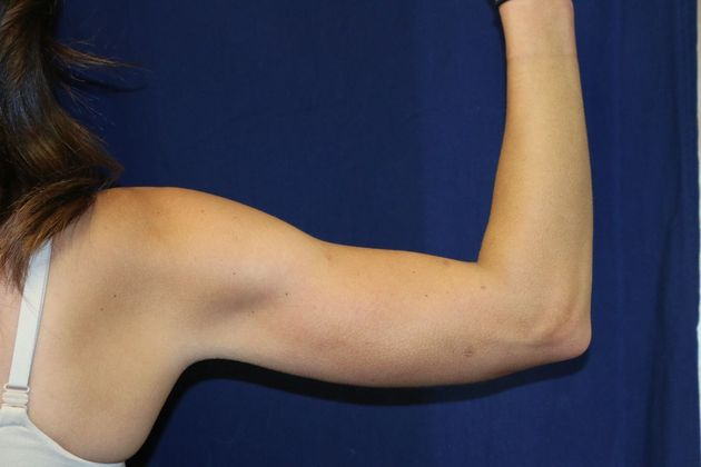 Arm Lift*/Arm Sculpting: Case 13 - After