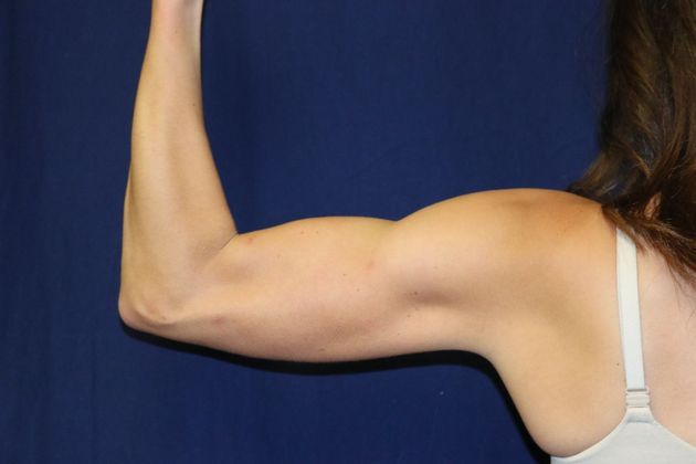 Arm Lift*/Arm Sculpting: Case 13 - After