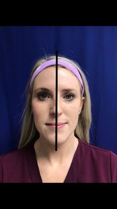 Injectables Botox, Dysport Neuromodulators Case 7 (2585634) - After