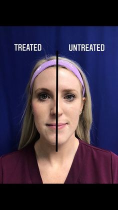 Injectables Botox, Dysport Neuromodulators Case 7 (2585634) - Before