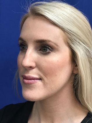 Injectables Botox, Dysport Neuromodulators: Case 7 (2585634) - After