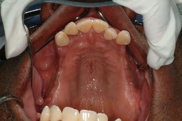 All-on-4/ Full Mouth Dental Implants / Teeth in a Day: Case 11-ED-All on 6 upper bridge - Before