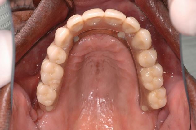 All-on-4/ Full Mouth Dental Implants / Teeth in a Day: Case 11-ED-All on 6 upper bridge - After