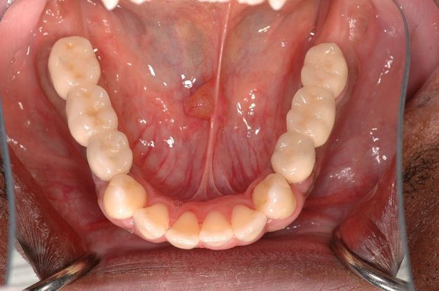 All-on-4/ Full Mouth Dental Implants / Teeth in a Day: Case 11-ED-All on 6 upper bridge - After