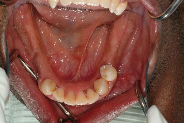 All-on-4/ Full Mouth Dental Implants / Teeth in a Day: Case 11-ED-All on 6 upper bridge - Before