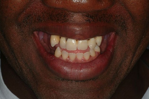 All-on-4/ Full Mouth Dental Implants / Teeth in a Day: Case 11-ED-All on 6 upper bridge - Before