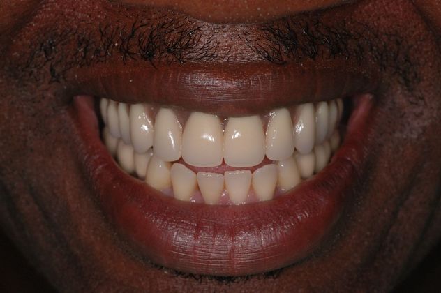 All-on-4/ Full Mouth Dental Implants / Teeth in a Day: Case 11-ED-All on 6 upper bridge - After