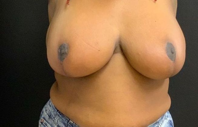 Breast Reduction Case 15 - After