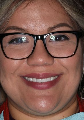 Dental Crowns: Case 5 - After