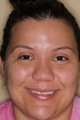 Dental Crowns: Case 5 - Before