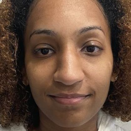 Rhinoplasty Case 29 Rhinoplasty Stratford, CT - Before