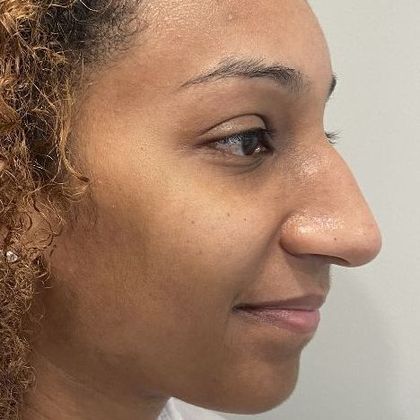 Rhinoplasty: Case 29 Rhinoplasty Stratford, CT - Before