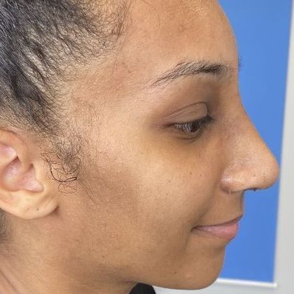 Rhinoplasty: Case 29 Rhinoplasty Stratford, CT - After